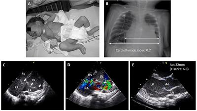 Cardiomyopathy in Genetic Aortic Diseases